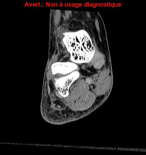 Baxter neuropathy (Radiopaedia 25988-26125 Coronal non-contrast 9).jpg