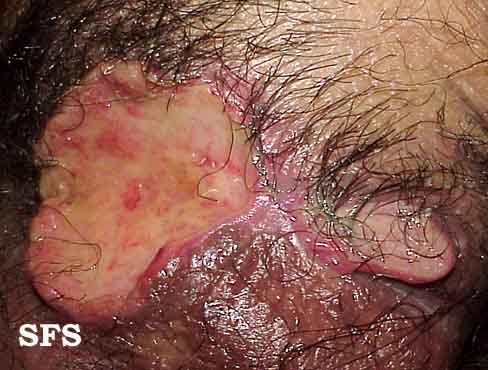 Behçet'S Syndrome (Dermatology Atlas 10).jpg