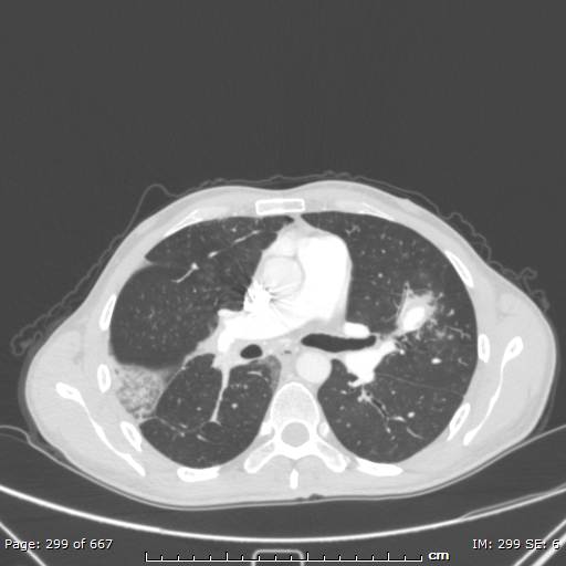 File:Behçet disease (Radiopaedia 44247-47889 Axial lung window 38).jpg
