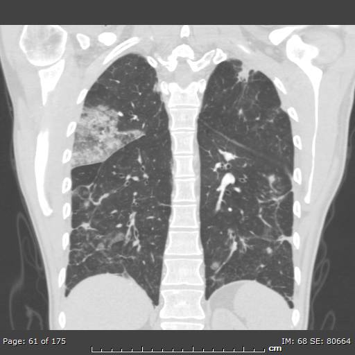 Behçet disease (Radiopaedia 44247-47889 Coronal lung window 16).jpg