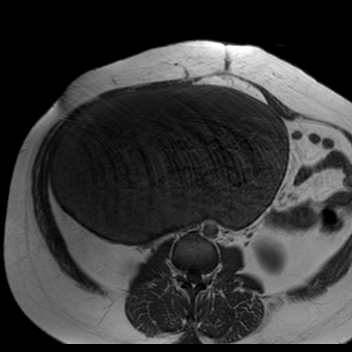 File:Benign seromucinous cystadenoma of the ovary (Radiopaedia 71065-81300 Axial T1 24).jpg