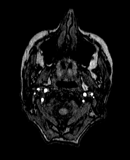 Berry aneurysm of the terminal internal carotid artery (Radiopaedia 88286-104918 Axial TOF 17).jpg