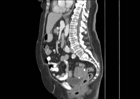 Bicameral celiacomesenteric aneurysm (Radiopaedia 55766-62327 B 30).jpg