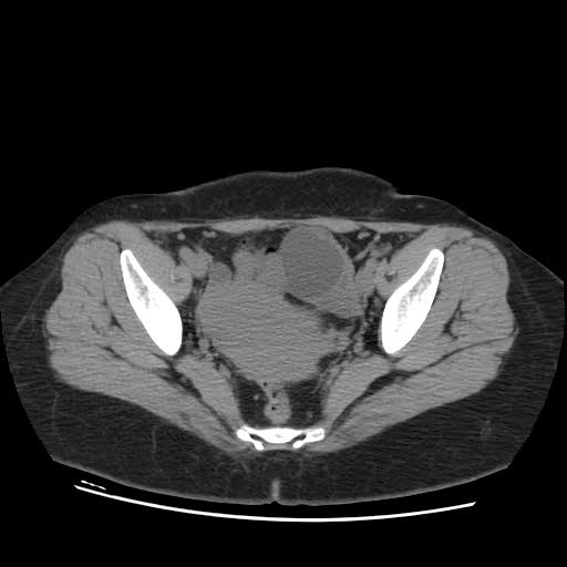 File:Bicornuate uterus- on MRI (Radiopaedia 49206-54296 Axial non-contrast 8).jpg