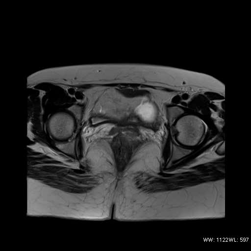 File:Bicornuate uterus- on MRI (Radiopaedia 49206-54297 Axial T2 12).jpg