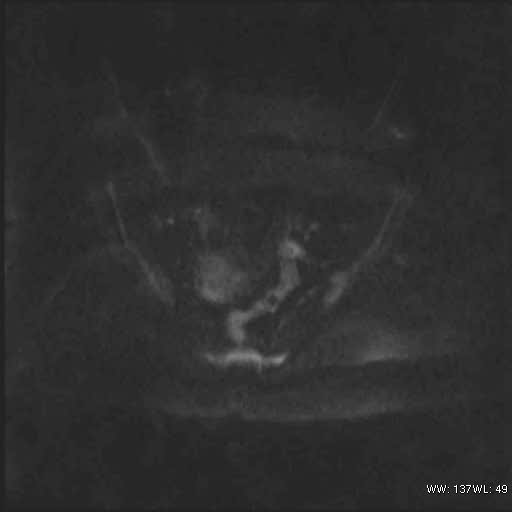 File:Bicornuate uterus (MRI) (Radiopaedia 49206-54297 Axial 102).jpg
