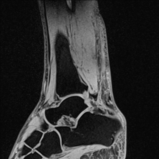 Bilateral Achilles tendon complete tear (Radiopaedia 81344-95051 Sagittal WE - Left 72).jpg