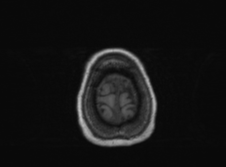 Bilateral PCA territory infarction - different ages (Radiopaedia 46200-51784 Axial T1 120).jpg