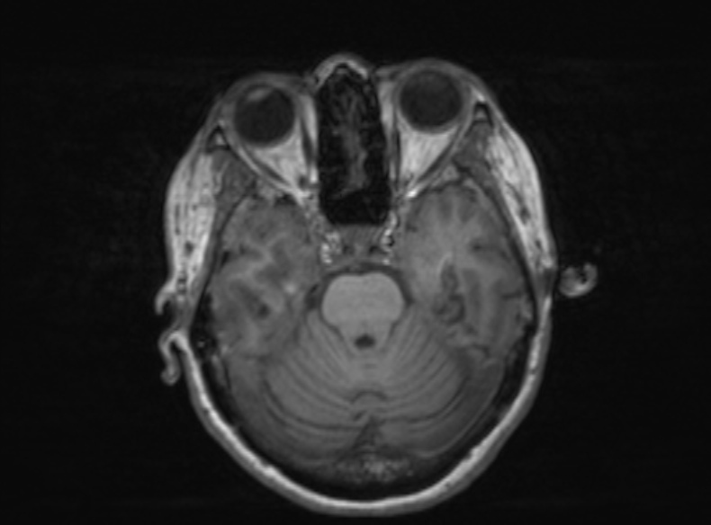 Bilateral PCA territory infarction - different ages (Radiopaedia 46200-51784 Axial T1 286).jpg
