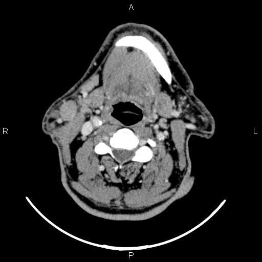 Bilateral Warthin tumors (Radiopaedia 84034-99263 Axial With contrast 35).jpg