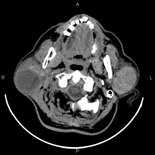 Bilateral Warthin tumors (Radiopaedia 84034-99263 Axial non-contrast 17).jpg