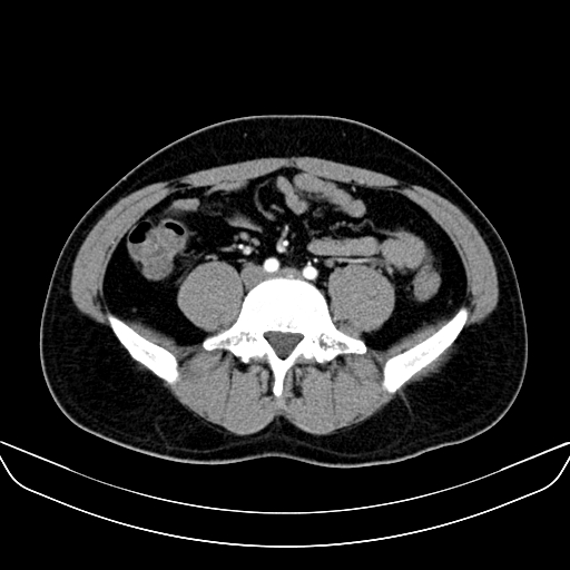 Bilateral accessory renal arteries with mild pelvi-ureteric junction (PUJ) obstruction (Radiopaedia 66357-75596 A 43).jpg