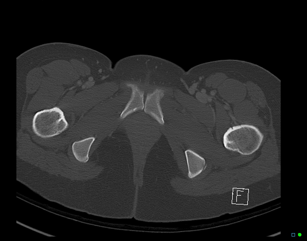 File:Bilateral acetabular fractures (Radiopaedia 79272-92308 Axial bone window 60).jpg