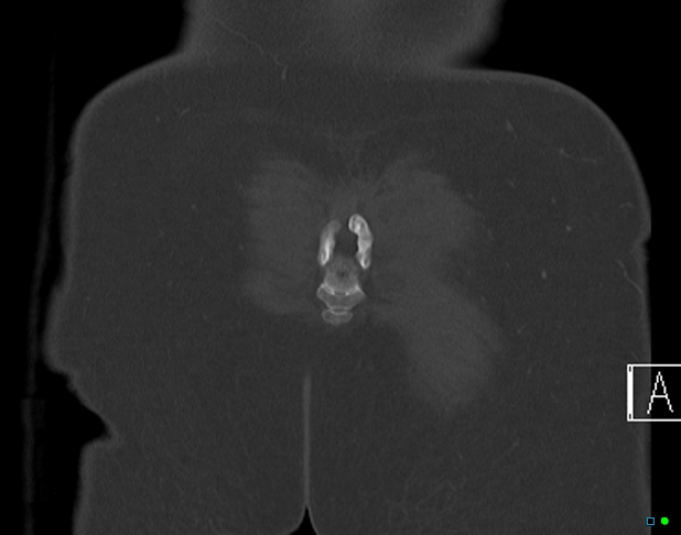 File:Bilateral acetabular fractures (Radiopaedia 79272-92308 Coronal bone window 46).jpg