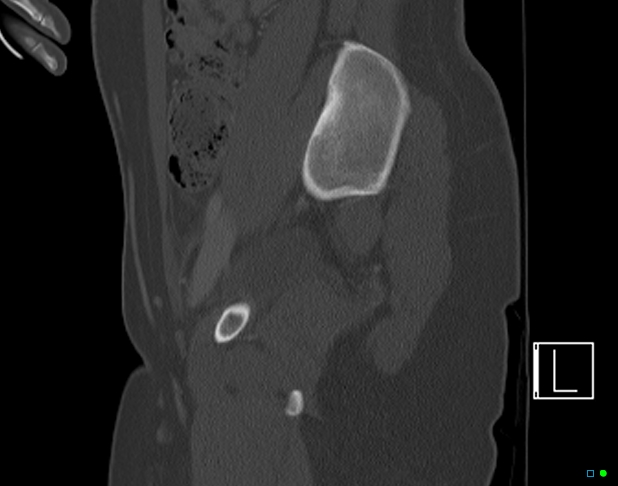 Bilateral acetabular fractures (Radiopaedia 79272-92308 Sagittal bone window 29).jpg