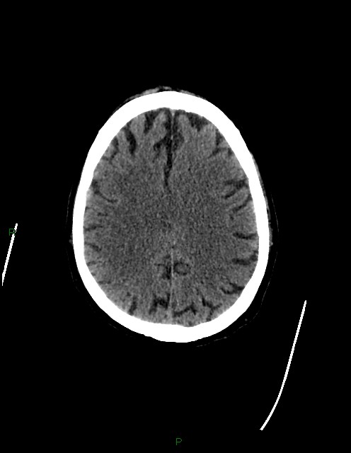 Bilateral acute middle cerebral artery territory infarcts (Radiopaedia 77319-89401 Axial non-contrast 61).jpg