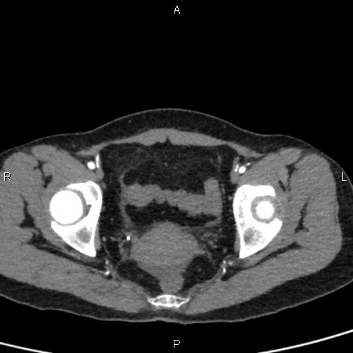 Bilateral adrenal gland hyperenhancement in pancreatitis (Radiopaedia 86642-102753 B 116).jpg