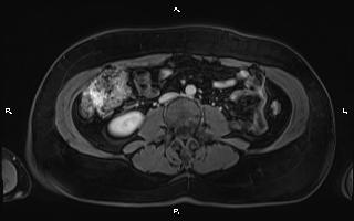 Bilateral adrenal myelolipoma (Radiopaedia 63058-71537 G 65).jpg
