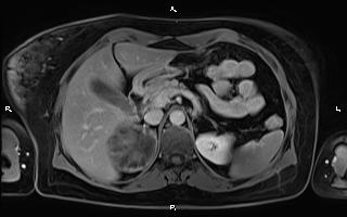 File:Bilateral adrenal myelolipoma (Radiopaedia 63058-71537 H 34).jpg