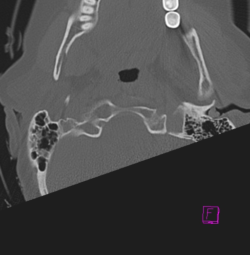 File:Bilateral atlanto-occipital assimilation (Radiopaedia 28350-28603 Axial bone window 3).jpg
