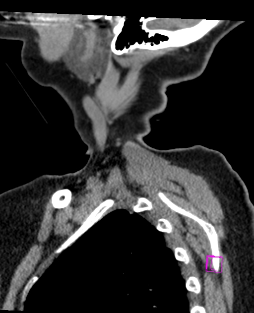 Bilateral atlanto-occipital assimilation (Radiopaedia 28350-28603 D 3).jpg