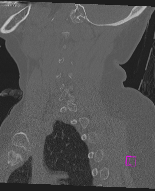 Bilateral atlanto-occipital assimilation (Radiopaedia 28350-28603 Sagittal bone window 57).jpg