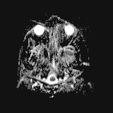Bilateral basal ganglia and thalamic T1 hyperintensities (Radiopaedia 19764-19802 Axial DWI 40).jpg