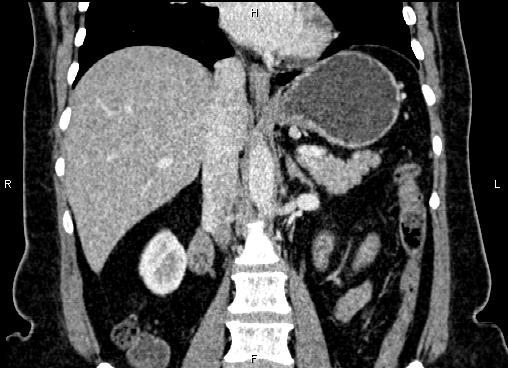 Bilateral benign adrenal adenomas (Radiopaedia 86912-103124 D 33).jpg