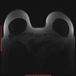 File:Bilateral breast implant rupture (Radiopaedia 24761-25027 PASTA 21).jpg