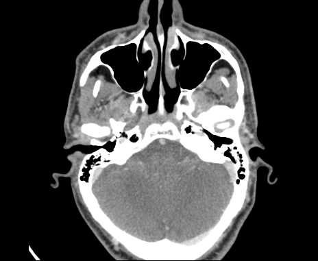 Bilateral carotid body tumors (Radiopaedia 61841-69870 Axial Post contrast 2).jpg
