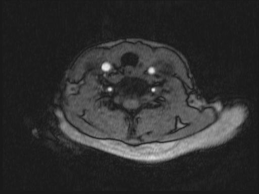 Bilateral carotid body tumors and right glomus jugulare tumor (Radiopaedia 20024-20060 Axial MRA 213).jpg