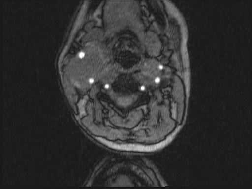 Bilateral carotid body tumors and right glomus jugulare tumor (Radiopaedia 20024-20060 Axial MRA 257).jpg