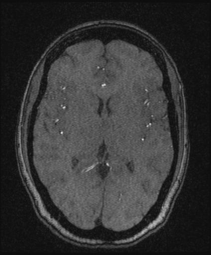 Bilateral carotid body tumors and right glomus jugulare tumor (Radiopaedia 20024-20060 Axial MRA 98).jpg