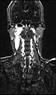 File:Bilateral carotid body tumors and right glomus jugulare tumor (Radiopaedia 20024-20060 MRA 112).jpg