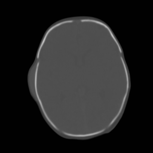 File:Bilateral cephalohematomas and subdural hematomas (Radiopaedia 26778-26929 Axial bone window 14).jpg