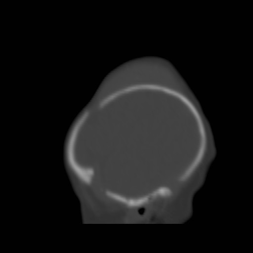 File:Bilateral cephalohematomas and subdural hematomas (Radiopaedia 26778-26929 Sagittal bone window 36).jpg