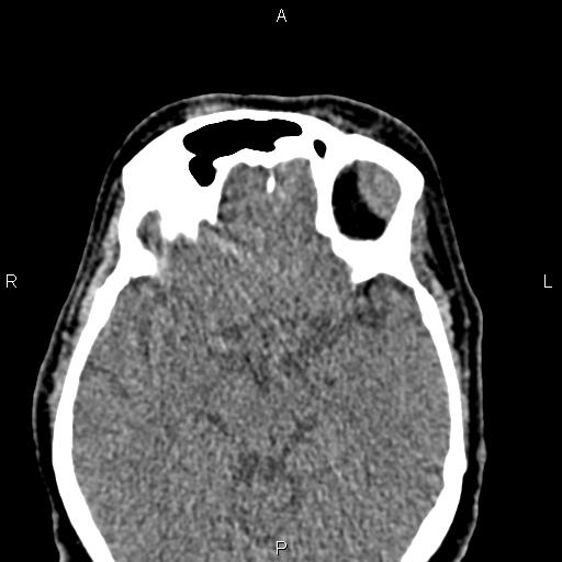 File:Bilateral enlargement of lacrimal glands - sarcoidosis (Radiopaedia 62627-70921 Axial non-contrast 64).jpg