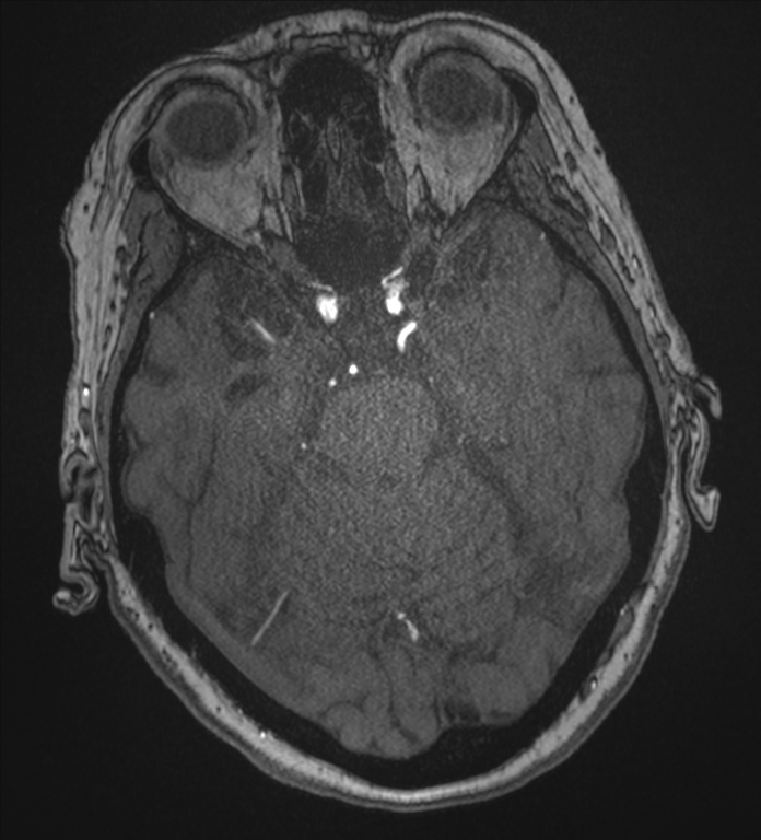 Bilateral fetal posterior communicating arteries (Radiopaedia 41286-44102 Axial MRA 68).png