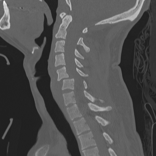 Bilateral locked facets (Radiopaedia 33850-35016 Sagittal bone window 23).png