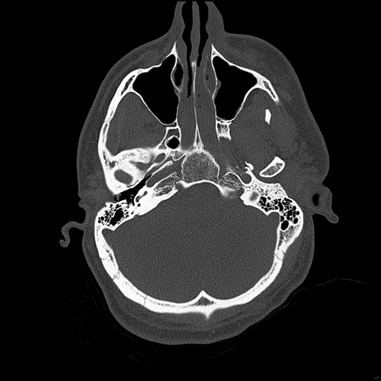 Bilateral occipital condyle fracture (type 2) (Radiopaedia 87675-104089 Axial bone thins 53).jpg