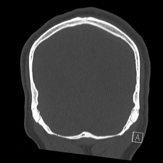 Bilateral occipital condyle fracture (type 2) (Radiopaedia 87675-104089 Coronal bone window 119).jpg