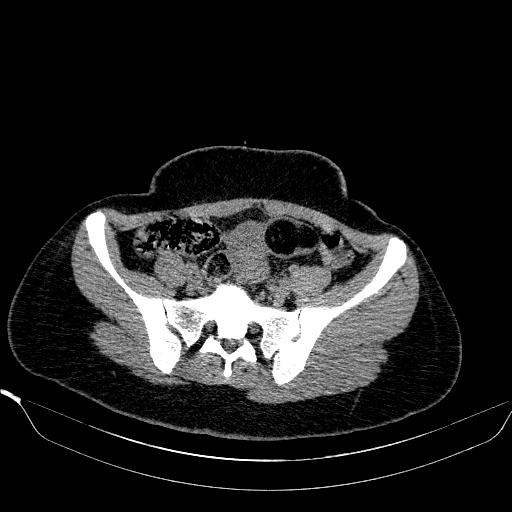 File:Bilateral ovarian dermoid (Radiopaedia 45714-49907 Axial non-contrast 12).JPEG
