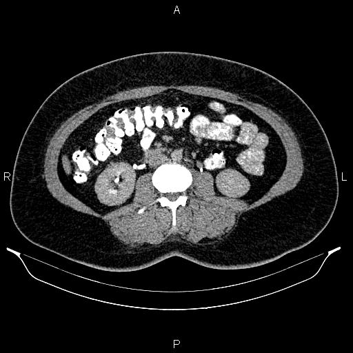 Bilateral ovarian dermoid cysts (Radiopaedia 85785-101603 Axial C+ delayed 37).jpg