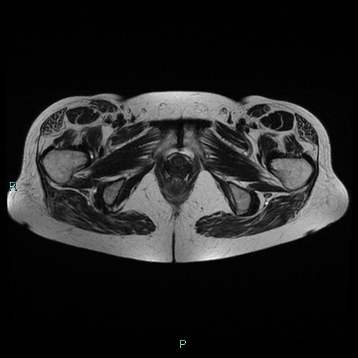 File:Bilateral ovarian fibroma (Radiopaedia 44568-48293 Axial T2 27).jpg
