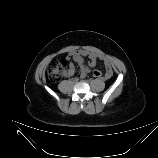 Bilateral ovarian mature cystic teratomas (Radiopaedia 79373-92457 Axial non-contrast 34).jpg