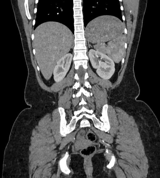 File:Bilateral ovarian mature cystic teratomas (Radiopaedia 79373-92457 B 71).jpg