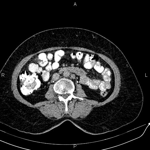 Bilateral ovarian serous cystadenocarcinoma (Radiopaedia 86062-101989 Axial C+ delayed 35).jpg