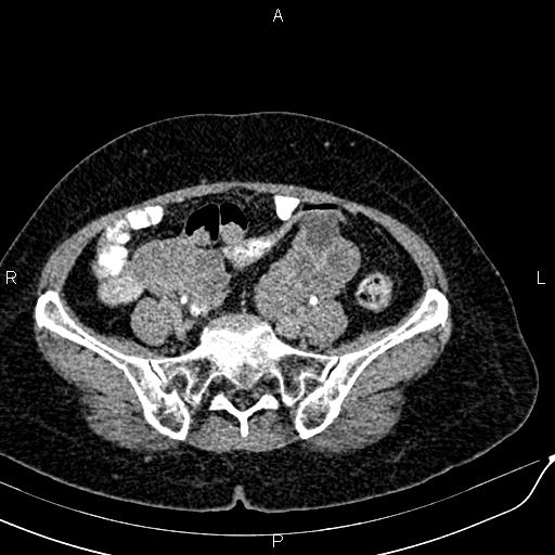 Bilateral ovarian serous cystadenocarcinoma (Radiopaedia 86062-101989 Axial C+ delayed 56).jpg