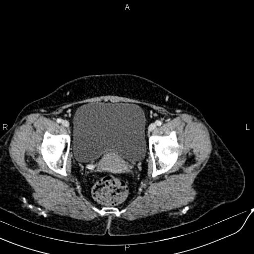 Bilateral ovarian serous cystadenocarcinoma (Radiopaedia 86062-101989 B 93).jpg