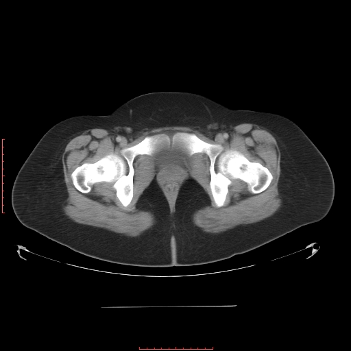 File:Bilateral ovarian serous cystadenocarcinoma with right ovarian torsion (Radiopaedia 32640-33611 A 43).jpg